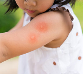 Mosquito Bites On Child